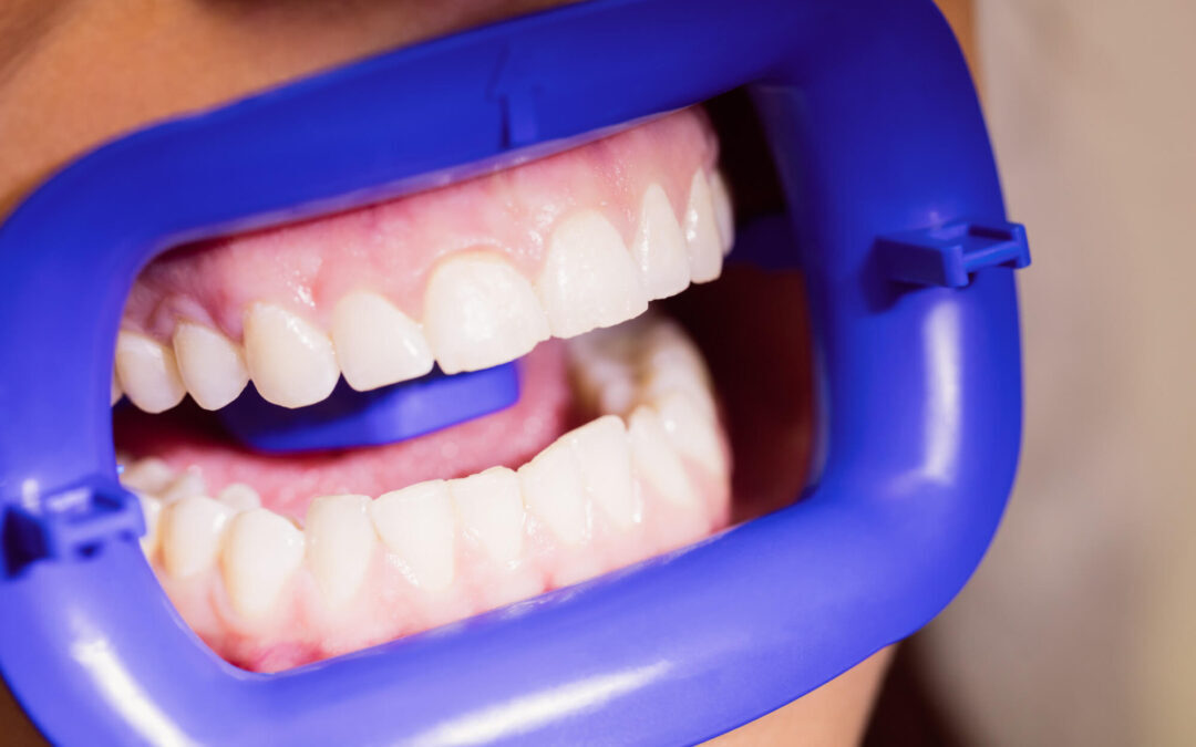 The Importance of Gum Care in Oral Health
