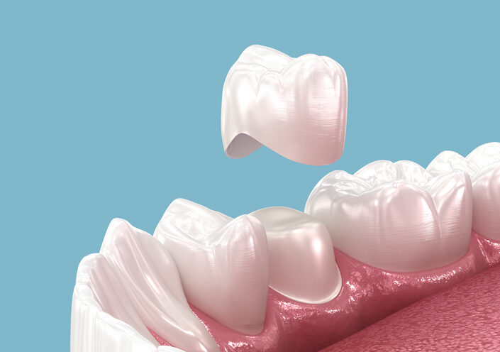 3D Dental Crown