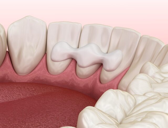 Dental Bridges