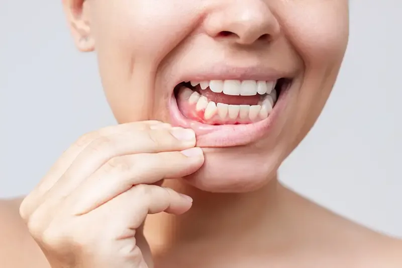Signs and Symptoms of Gum Disease