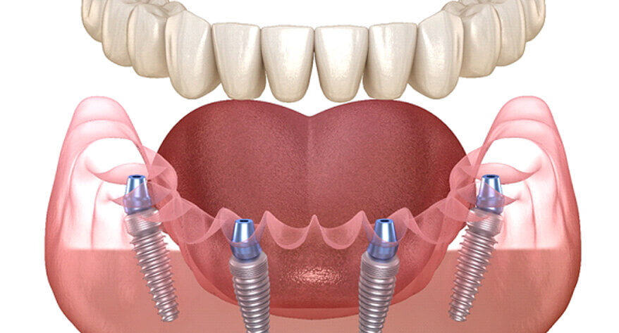 Full and Partial Dentures