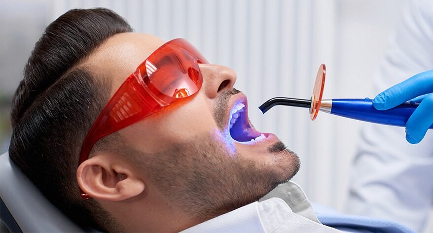 Dental Sealants